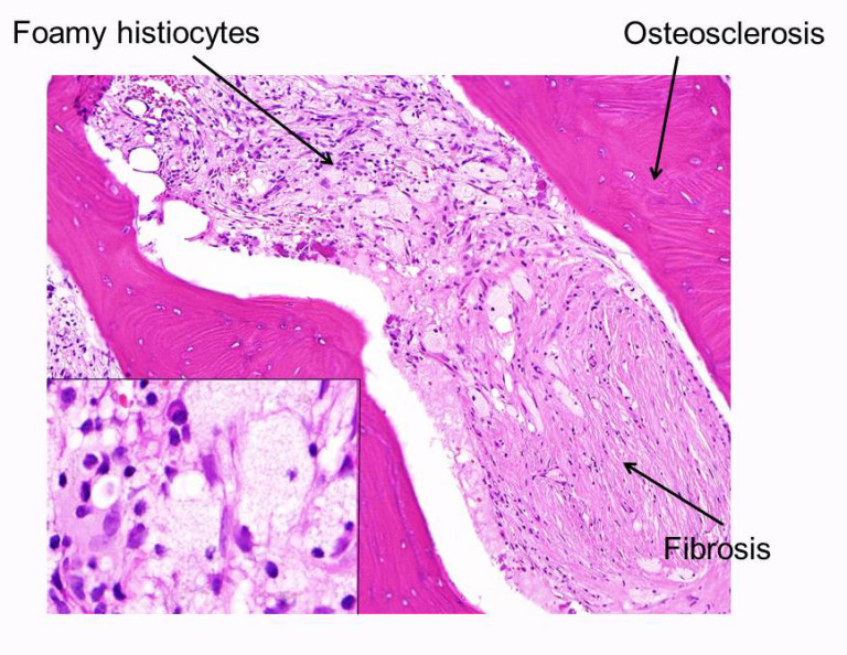 Erdheim Chester composite ErdheimChester Disease